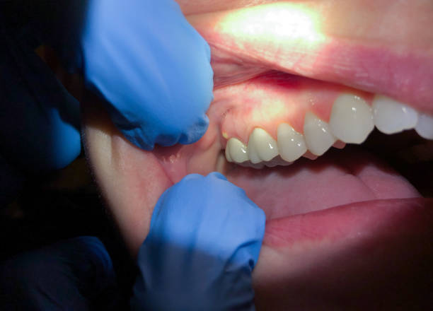 Best Emergency Dentist for Lost Fillings or Crowns in Orwigsburg, PA